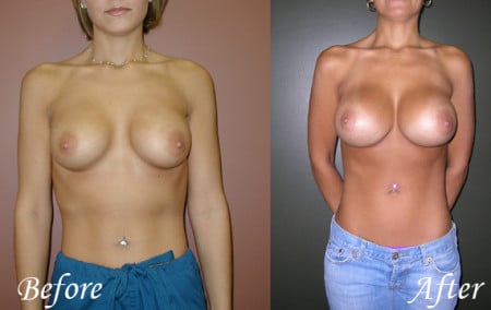 Revisional Breast Surgery