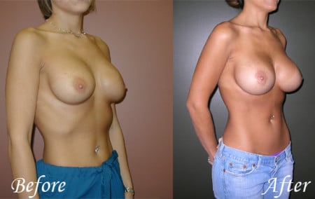 Revisional Breast Surgery