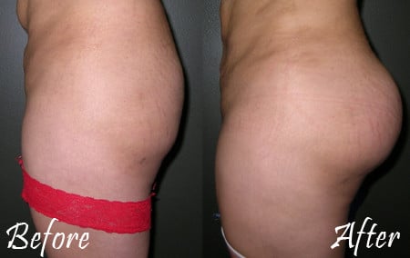 Butt Augmentation with Implants